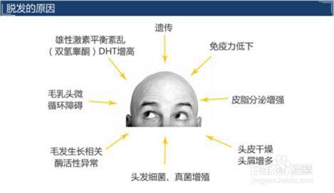 脂溢性脱发能治好吗分享5个脂溢性脱发经验