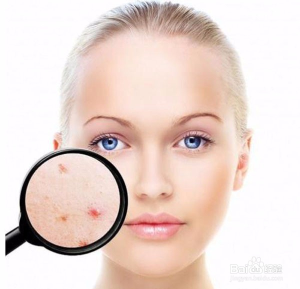 常犯的祛痘误区有哪些？