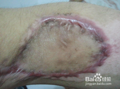 治疗老烂腿的方法