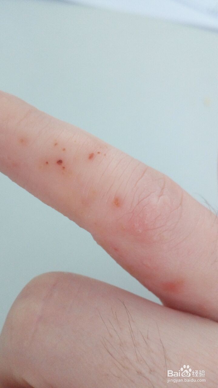 手指小水泡的治疗过程（真实经验）