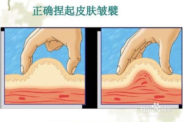 注射胰岛素应该怎样消毒？