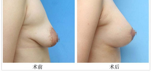 乳房下垂矫正