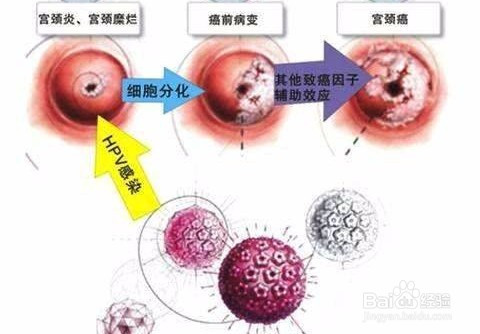 hpv病毒是否可以發展成宮頸癌