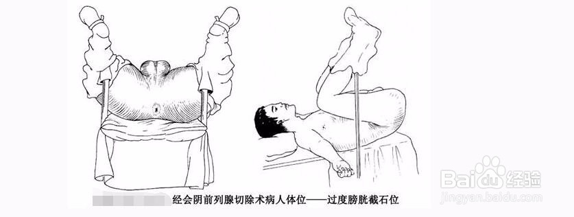 男人如何做才有利于减少前列腺问题的产生