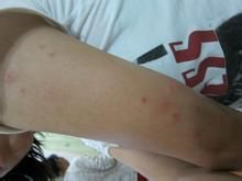 吃海鲜过敏的原因及应对方法