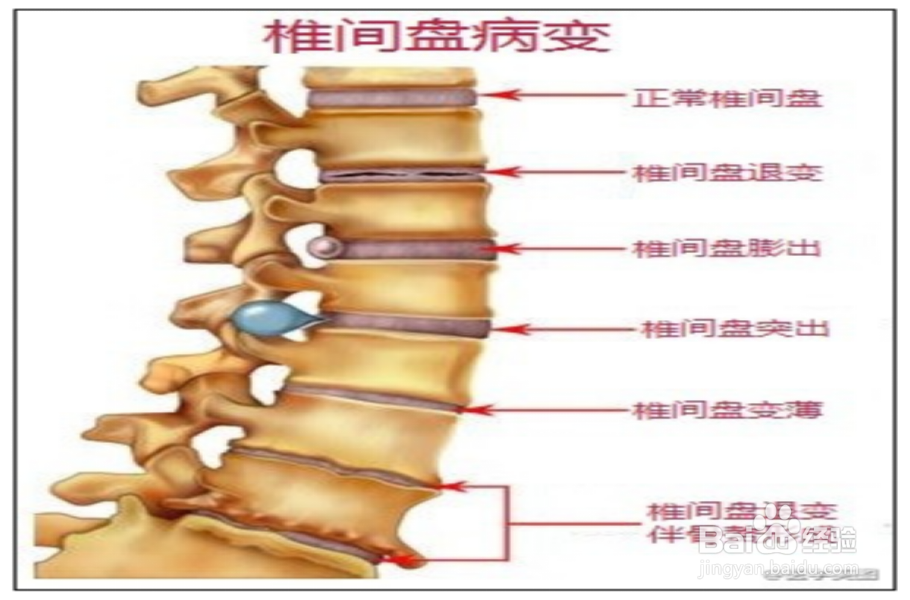 椎间盘突出阶梯式治疗方法介绍