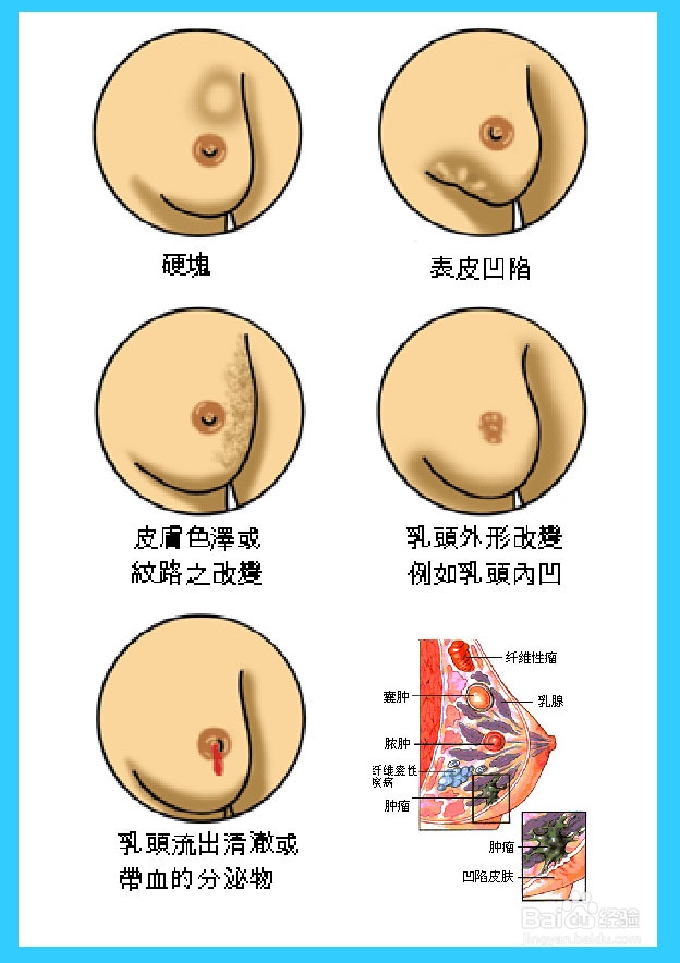 乳腺癌晚期症状都有哪些