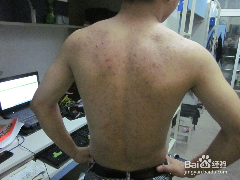 背部长痘痘应该怎么办
