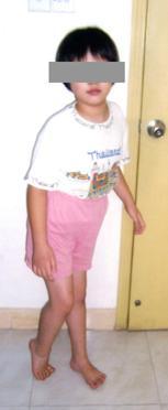 脑瘫的症状有哪些？