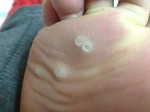 鸡眼根治方法