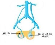 精索静脉曲张的症状有哪些