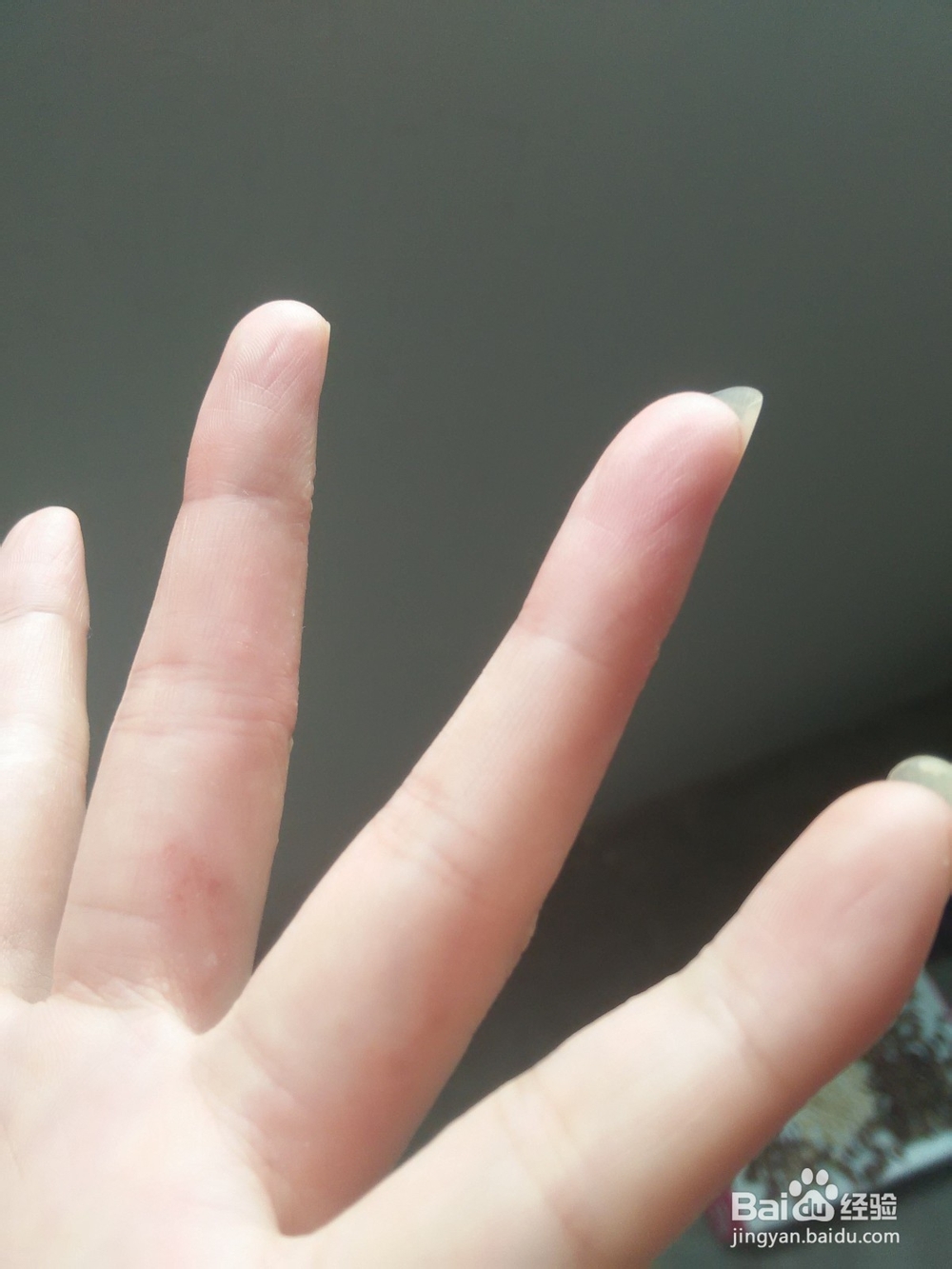 分享手上长水泡如何治愈的方法