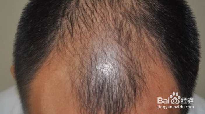 男士头发掉得很严重,应该怎么办