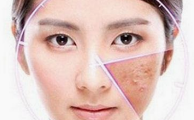 怎么才能把痘印去掉