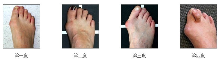 大脚骨如何治疗