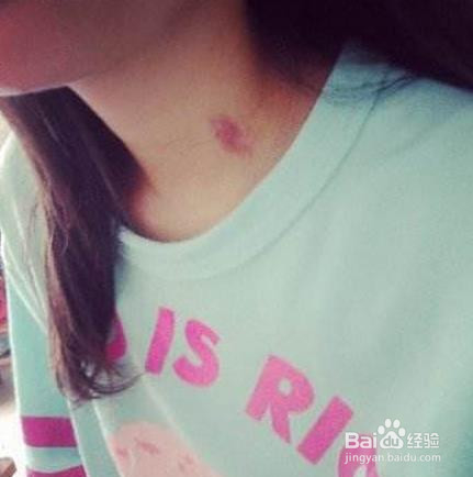 脖子吻痕怎么消除
