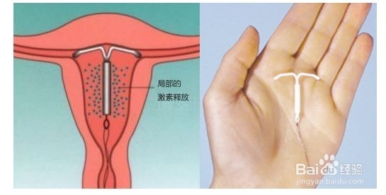 你知道多少种避孕方法呢让我来告诉你!