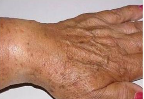 手上长老年斑怎么办