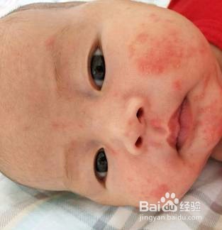 过敏性体质怎么办