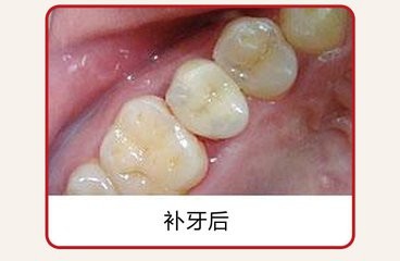 合肥补牙多少钱一颗