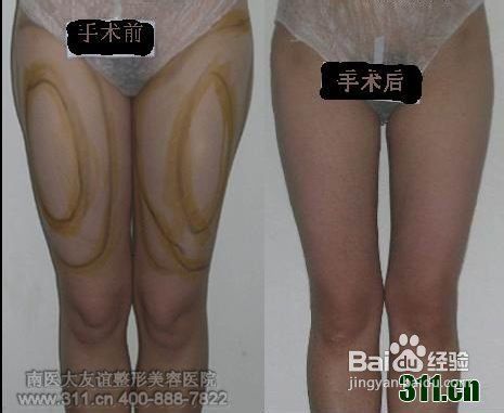 瘦大腿哪个方法好