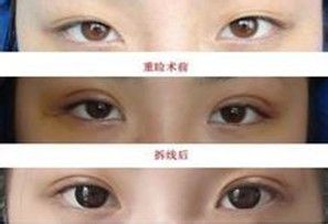 割双眼皮手术价格是多少