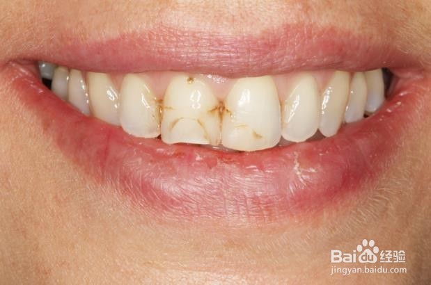 伤害牙齿的常见错误