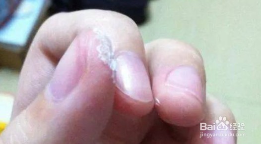 手上干透了的502怎么洗掉