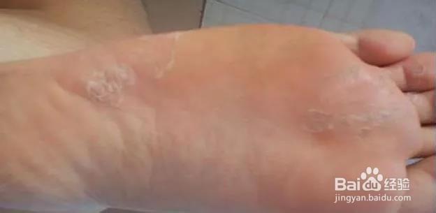 脚气怎么预防和缓解？