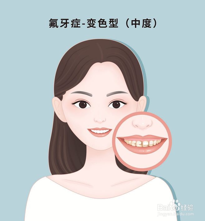 如何治疗氟牙症