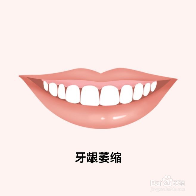 什么是牙龈萎缩?有什么危害?