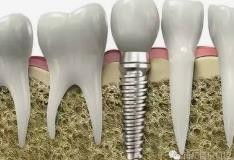 种牙后注意事项