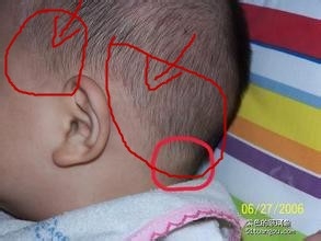 小孩突发高烧怎么办