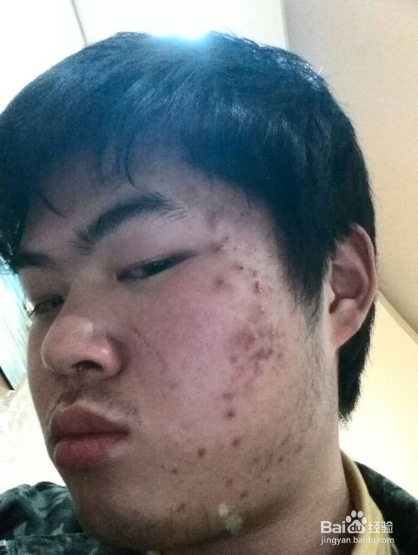 怎么样消除青春痘