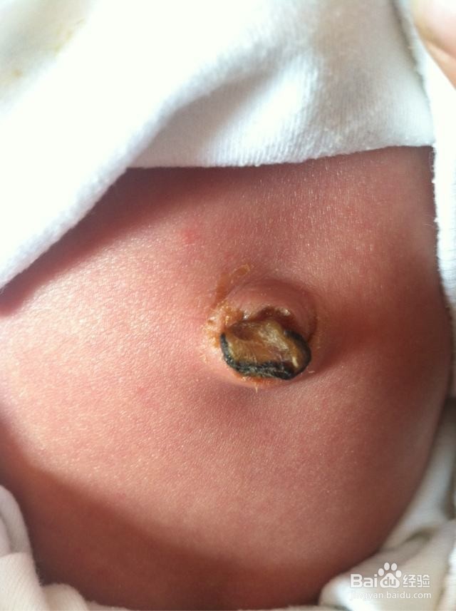 新生宝宝的肚脐应该如何护理？