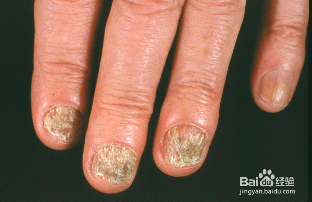 你喜欢咬指甲吗？咬指甲不加重视，或发展为强迫症