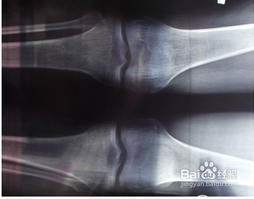 骨骼闭合还能长高吗