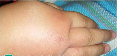 核桃树上虫子蛰了怎么办