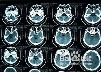 鼻腔囊肿怎么办