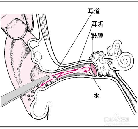 耵聍对生活的影响及如何正确挖取耵聍