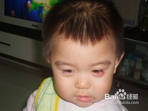 家长们如何预防小儿麦粒肿
