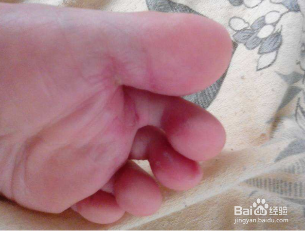 脚趾缝痒溃烂怎么办