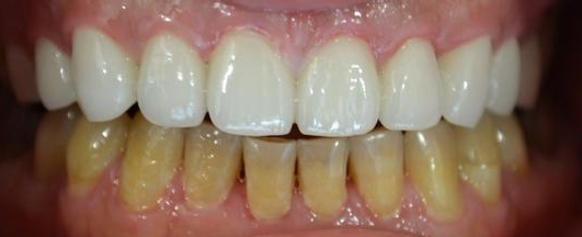 牙齿贴面的优势