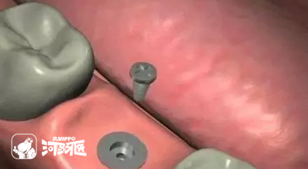 几张图让你看明白种植牙的过程！