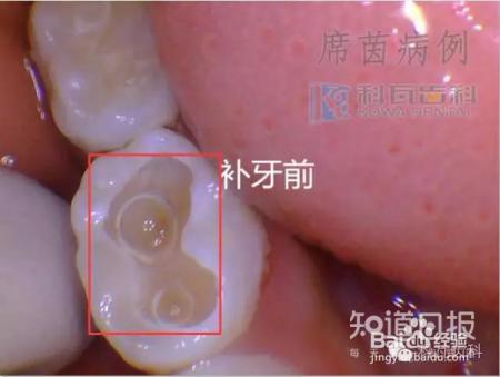 孩子六龄齿窝沟封闭有必要吗?九成父母都不知道