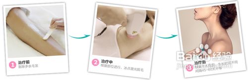 什么是冰点脱毛？