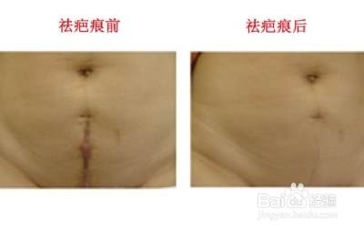 欣疤克祛疤真的有用吗?