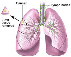 肺癌的前期表现