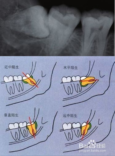 <b>智齿萌出后常见问题的建议</b>