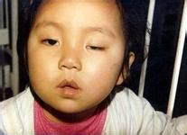 哪些是肌无力的症状表现